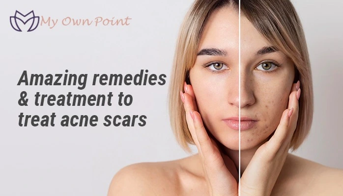 Treat Acne Scars